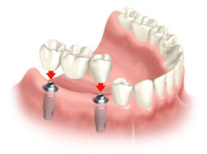 Middletown New Jersey Dentist | Dental Implant Middletown and Hamilton NJ