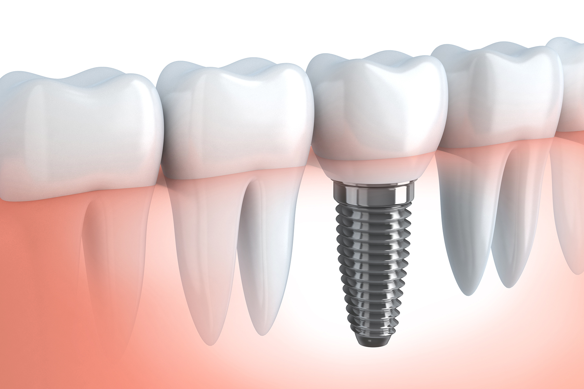 Types of dental implants used at Rockwell Dentistry in Middletown, NJ