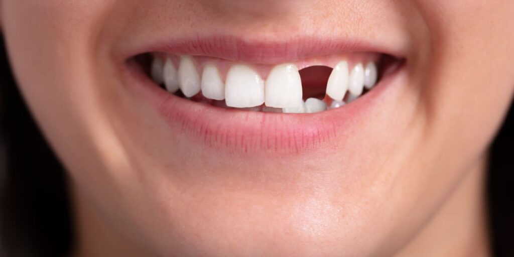Replacing Missing Teeth