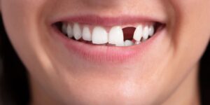 Middletown New Jersey Dentist | Replacing Missing Teeth: The Complete Guide for Adults and Seniors