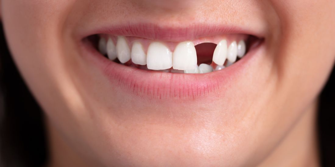 Replacing Missing Teeth