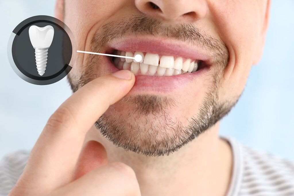 Dental Implants in Middletown, NJ: A Strong Foundation for a Confident Smile
