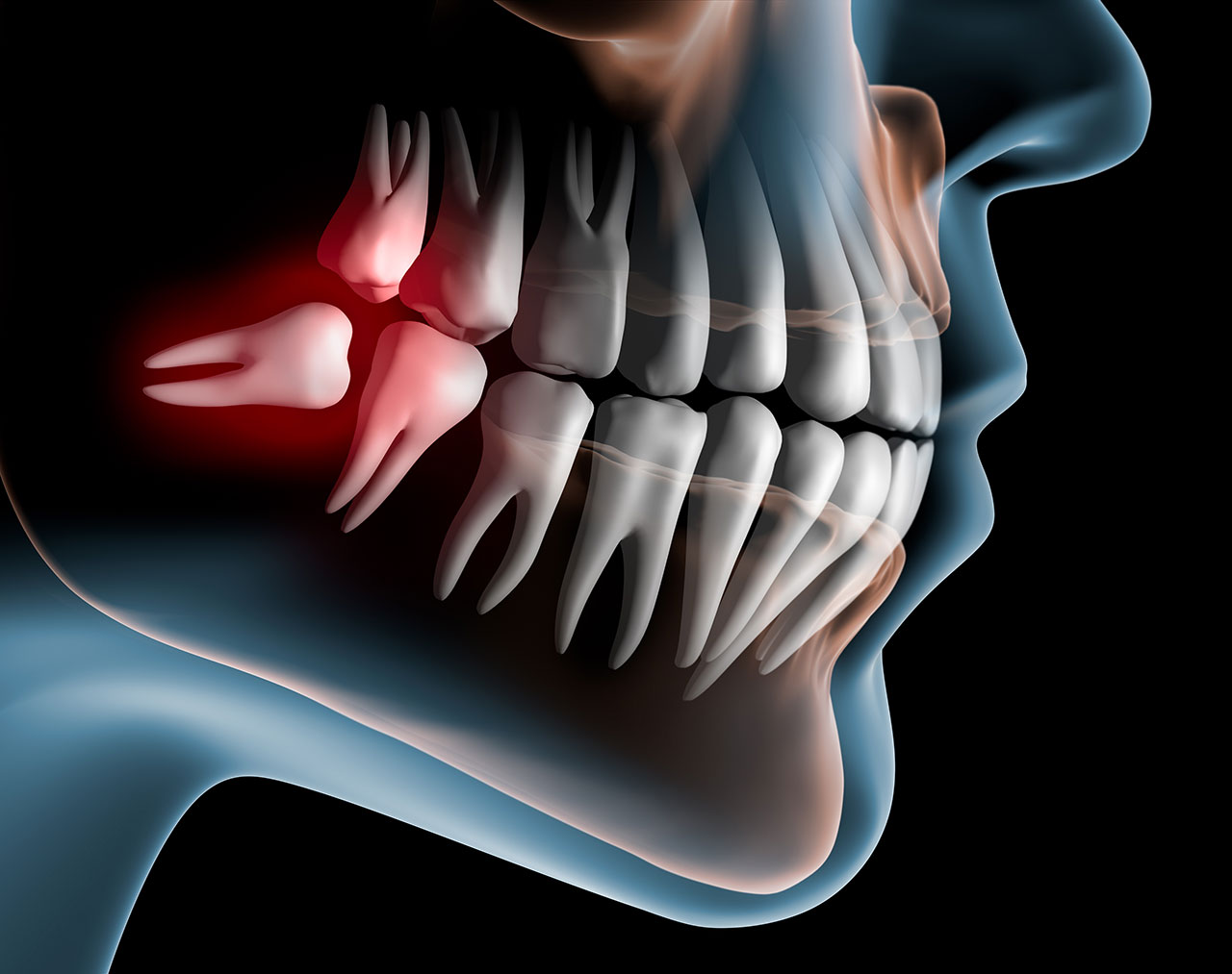 Wisdom Teeth Removal In Middletown, NJ: What To Expect Before, During, And After