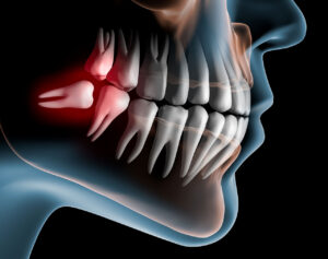 Middletown New Jersey Dentist | Wisdom Teeth Removal in Middletown, NJ: Making Room for a Healthier Smile